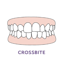 Crossbite