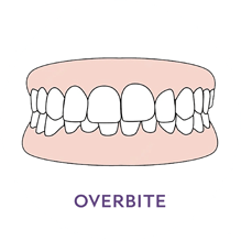 Overbite