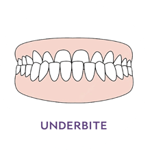 Underbite